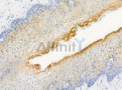 Phospho-TNNI3 (Ser44) Antibody - AF3215 at 1/100 staining human cervical carcinoma by IHC-P.
