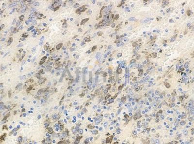 Phospho-NF kappaB p105/p50 (Ser927) Antibody - AF3217 at 1/100 staining human melanoma by IHC-P.