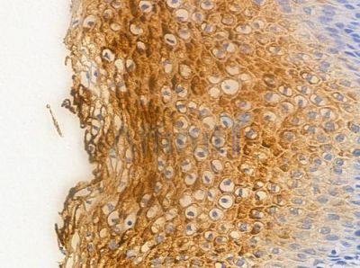 Phospho-NF kappaB p105/p50 (Ser337) Antibody - AF3219 at 1/100 staining human cervical carcinoma by IHC-P.