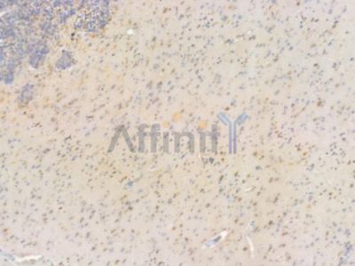 Phospho-NF kappaB p105/p50 (Ser893) Antibody - AF3220 at 1/100 staining human glioblastoma by IHC-P.