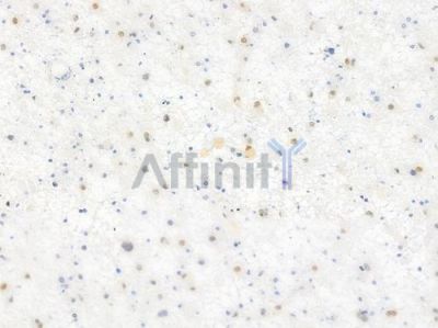 Phospho-NF kappaB p105/p50 (Ser907) Antibody - AF3221 at 1/100 staining human astrocytoma by IHC-P.