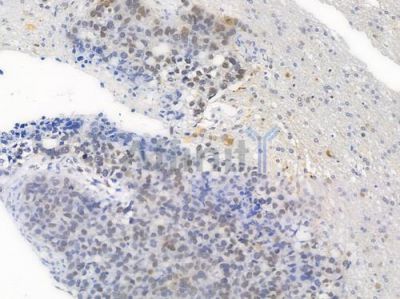 Phospho-NF kappaB p105/p50 (Ser907) Antibody - AF3221 at 1/100 staining human glioblastoma by IHC-P.