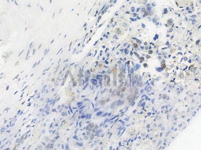 Phospho-NF kappaB p105/p50 (Ser907) Antibody - AF3221 at 1/100 staining human prostate carcinoma by IHC-P.