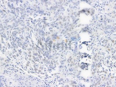 Phospho-NF kappaB p105/p50 (Ser907) Antibody - AF3221 at 1/100 staining human lung squamous cell carcinoma by IHC-P.