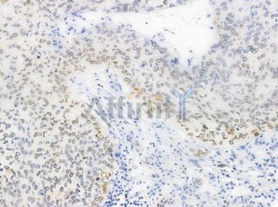 Phospho-NF kappaB p105/p50 (Ser907) Antibody - AF3221 at 1/100 staining human lung squamous cell carcinoma by IHC-P.