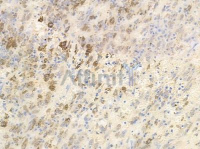 Phospho-p70 S6 Kinase (Ser424)[Ser447] Antibody - AF3230 at 1/100 staining human melanoma by IHC-P.