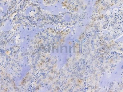 Phospho-Cyclin E1 (Thr395) Antibody - AF3235 at 1/100 staining human lung adenocarcinoma by IHC-P.