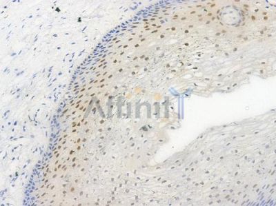 Phospho-Cyclin E1 (Thr395) Antibody - AF3235 at 1/100 staining human cervical carcinoma by IHC-P.