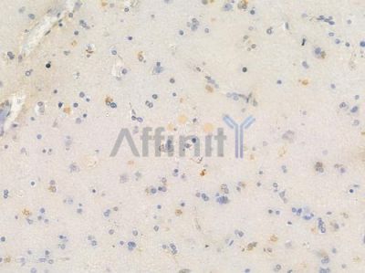Phospho-IKB alpha (Tyr305) Antibody - AF3239 at 1/100 staining human glioblastoma by IHC-P.