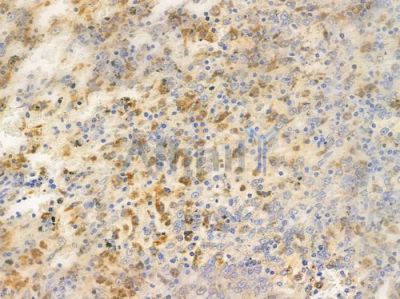 Phospho-IKB alpha (Tyr305) Antibody - AF3239 at 1/100 staining human melanoma by IHC-P.