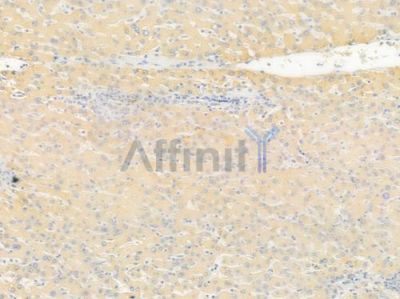 Phospho-SHC (Tyr349) Antibody - AF3245 at 1/100 staining human hepatocellular carcinoma by IHC-P.