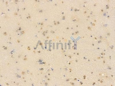 Phospho-CDC25C (Ser216) Antibody - AF3258 at 1/100 staining human glioblastoma by IHC-P.