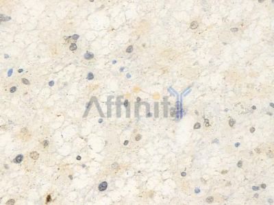 Phospho-CDC25C (Ser216) Antibody - AF3258 at 1/100 staining human astrocytoma by IHC-P.