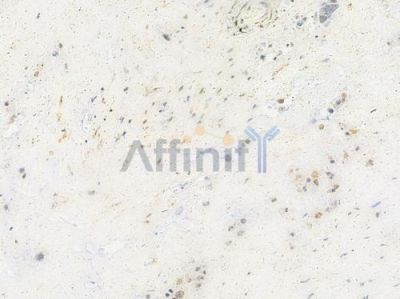 Phospho-CDC25C (Ser216) Antibody - AF3258 at 1/100 staining human pancreatic carcinoma by IHC-P.