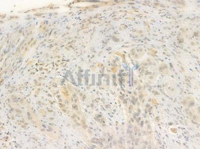 Phospho-CDC25C (Ser216) Antibody - AF3258 at 1/100 staining human tongue carcinoma by IHC-P.