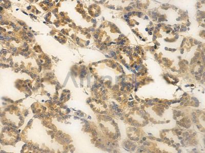 Phospho-AKT2 (Ser474) Antibody - AF3264 at 1/100 staining human renal cell carcinoma by IHC-P.