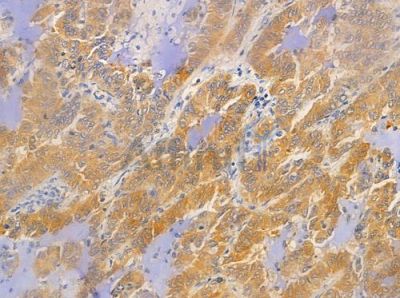 Phospho-AKT2 (Ser474) Antibody - AF3264 at 1/100 staining human lung adenocarcinoma by IHC-P.