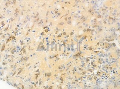 Phospho-beta Catenin (Ser37) Antibody - AF3266 at 1/100 staining human melanoma by IHC-P.