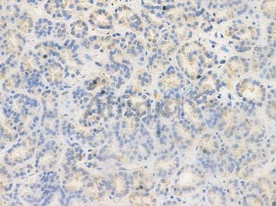 Phospho-iNOS (Tyr151) Antibody - AF3270 at 1/100 staining human renal cell carcinoma by IHC-P.