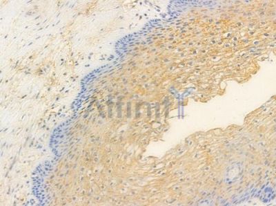 Phospho-iNOS (Tyr151) Antibody - AF3270 at 1/100 staining human cervical carcinoma by IHC-P.