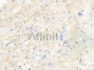 Phospho-VEGFR2 (Tyr1214) Antibody - AF3280 at 1/100 staining human astrocytoma by IHC-P.