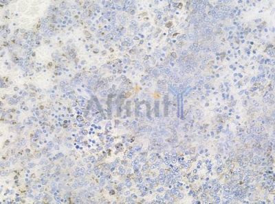 Phospho-MEK2 (Thr394) Antibody - AF3282 at 1/100 staining human melanoma by IHC-P.