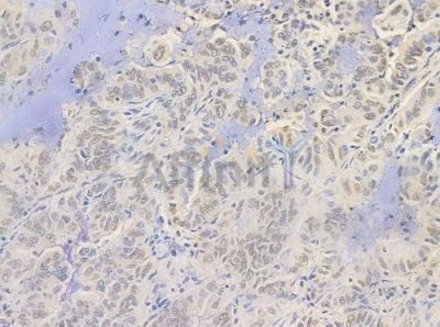 Phospho-HNF4 alpha (Ser313) Antibody - AF3297 at 1/100 staining human lung adenocarcinoma by IHC-P.