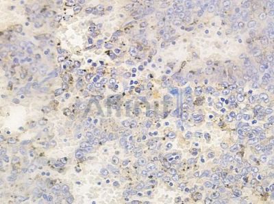 Phospho-MAP3K8/COT (Thr290) Antibody - AF3298 at 1/100 staining human melanoma by IHC-P.