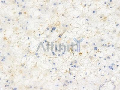 Phospho-GluR2 (Ser880) Antibody - AF3307 at 1/100 staining human astrocytoma by IHC-P.