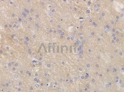 Phospho-GluR2 (Ser880) Antibody - AF3307 at 1/100 staining human glioblastoma by IHC-P.