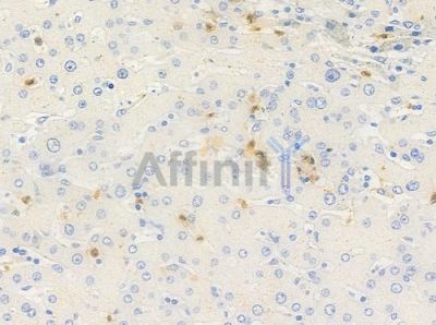 Phospho-MEK4/MKK4 (Thr261) Antibody - AF3322 at 1/100 staining human hepatocellular carcinoma by IHC-P.