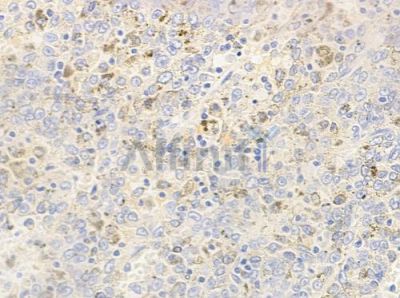 Phospho-GSK3 alpha (Ser21) Antibody - AF3336 at 1/100 staining human melanoma by IHC-P.