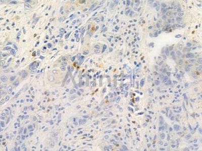 Phospho-PTEN (Ser370) Antibody - AF3351 at 1/100 staining human esophageal carcinoma by IHC-P.