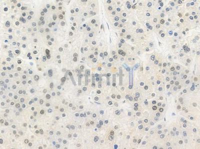 Acetyl-Histone H4 (Lys5) Antibody - AF3355 at 1/100 staining human hepatocellular carcinoma by IHC-P.