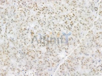 Acetyl-Histone H4 (Lys5) Antibody - AF3355 at 1/100 staining human renal cell carcinoma by IHC-P.