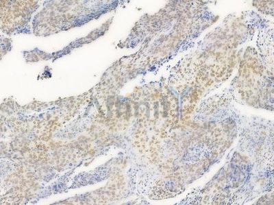 Acetyl-Histone H4 (Lys5) Antibody - AF3355 at 1/100 staining human cervical carcinoma by IHC-P.