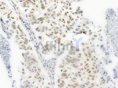 Acetyl-Histone H4 (Lys5) Antibody - AF3355 at 1/100 staining human lung squamous cell carcinoma by IHC-P.