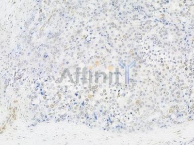 Acetyl-Histone H4 (Lys5) Antibody - AF3355 at 1/100 staining human prostate carcinoma by IHC-P.