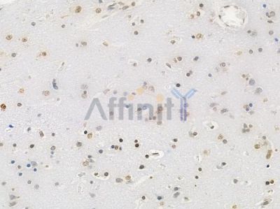 Acetyl-Histone H4 (Lys5) Antibody - AF3355 at 1/100 staining human glioblastoma by IHC-P.