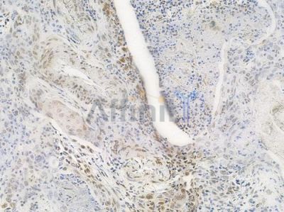 Acetyl-Histone H4 (Lys5) Antibody - AF3355 at 1/100 staining human esophageal carcinoma by IHC-P.