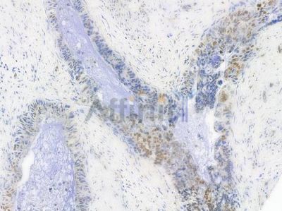 Acetyl-Histone H4 (Lys5) Antibody - AF3355 at 1/100 staining human pancreatic carcinoma by IHC-P.