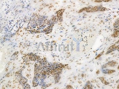 Acetyl-Histone H4 (Lys5) Antibody - AF3355 at 1/100 staining human breast carcinoma by IHC-P.
