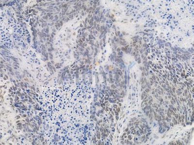 Acetyl-Histone H4 (Lys5) Antibody - AF3355 at 1/100 staining human large cell lung carcinoma by IHC-P.