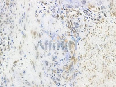 Acetyl-Histone H4 (Lys5) Antibody - AF3355 at 1/100 staining human gastric carcinoma by IHC-P.