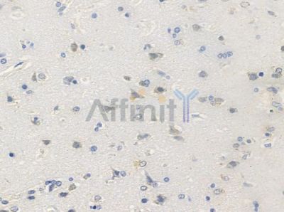 Phospho-NF kappaB p100/p52 (Ser866) Antibody - AF3373 at 1/100 staining human glioblastoma by IHC-P.