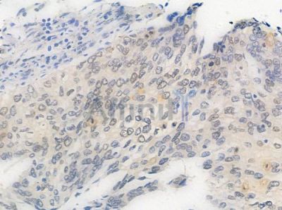 Phospho-MEF2A (Thr312) Antibody - AF3381 at 1/100 staining human cervical carcinoma by IHC-P.