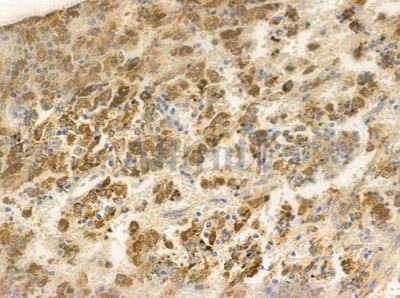 Phospho-NF-kB p65 (Ser468) Antibody - AF3390 at 1/100 staining human melanoma by IHC-P.