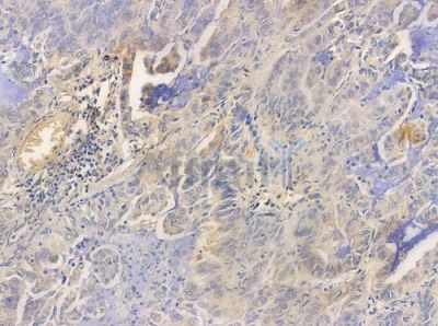 Phospho-NF-kB p65 (Thr254) Antibody - AF3391 at 1/100 staining human lung adenocarcinoma by IHC-P.