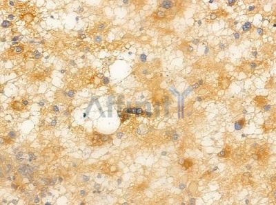 Phospho-PKC delta (Ser645) Antibody - AF3408 at 1/100 staining human astrocytoma by IHC-P.