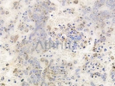 Phospho-PKC delta (Tyr64) Antibody - AF3410 at 1/100 staining human melanoma by IHC-P.